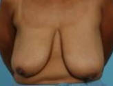 Patient # 32675 Before Photo # 1